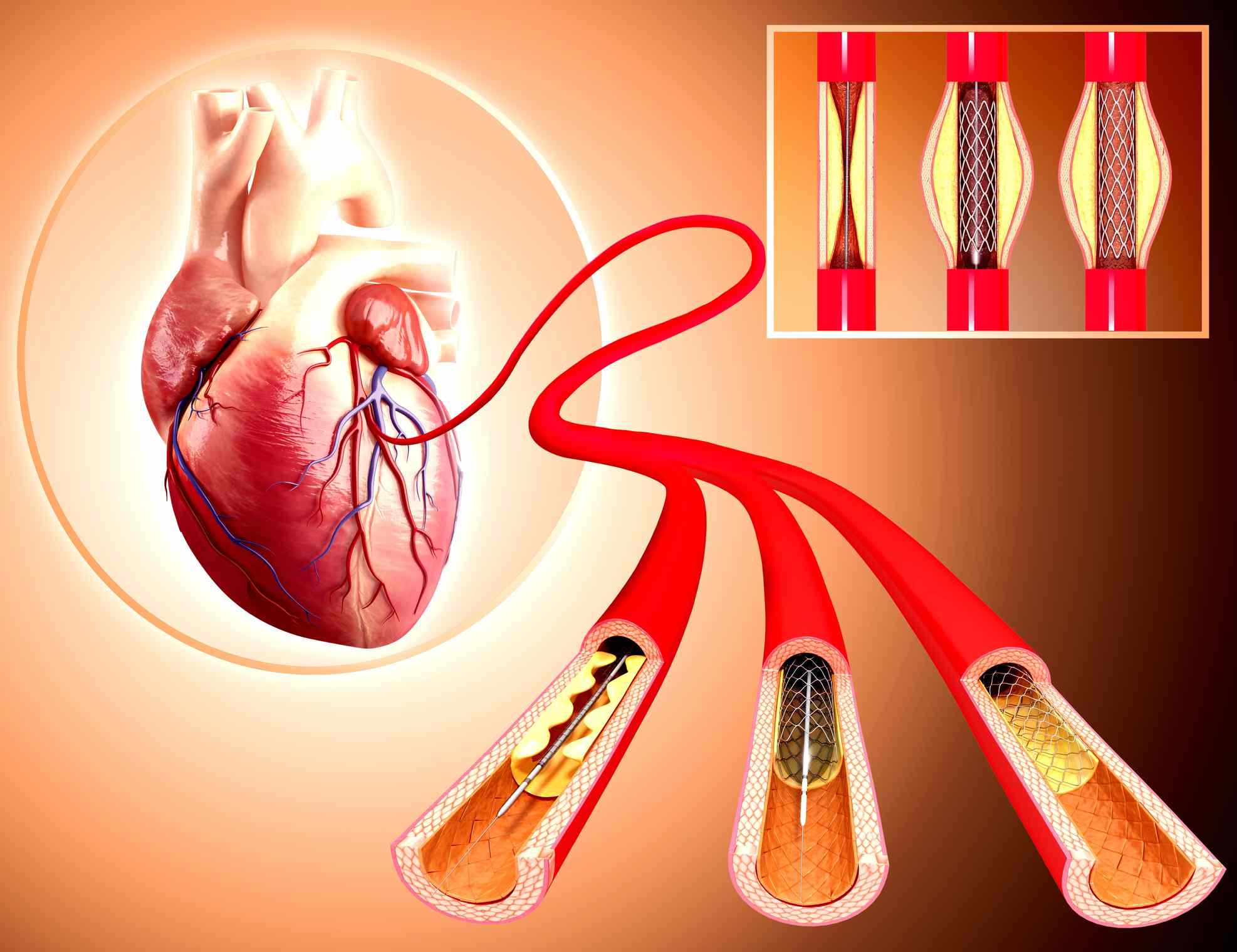 coronary-angiography-angioplasty-synergy-heart-institute